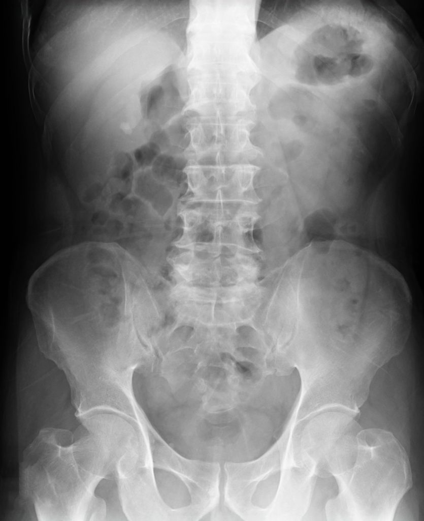 Spine And Nerve Pain X-Ray